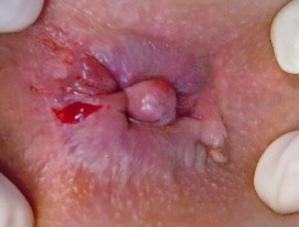 makat yırtığı görseli