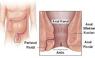 Anal Fistül