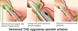 Hemoroid THD yöntemi