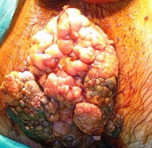 erkekte kondilom tedavisi