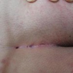 izmir mikro sinüsektomi