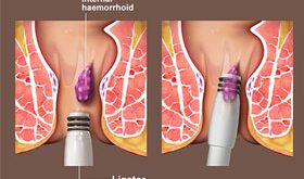 Ameliyatsız Basur Tedavisi