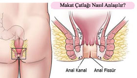 Makat Çatlağı Neden OLur?